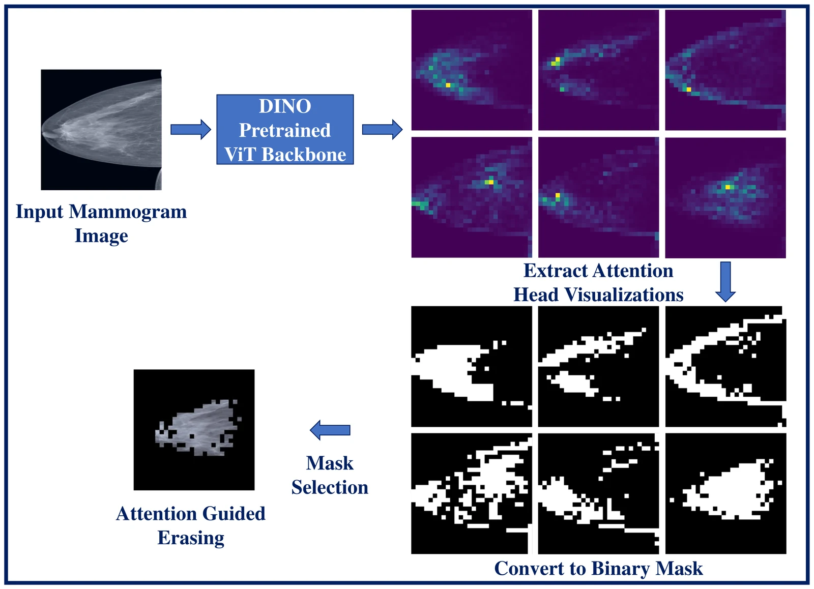 Method diagram: an input mammogram passes through a DINO-pretrained Vision Transformer backbone, producing six attention head visualizations, which are converted into six binary masks; after mask selection the result is a single attention-guided erased mammogram showing only the dense tissue region