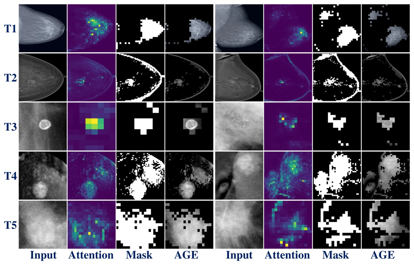 Five task rows showing input mammogram, selected attention map, binary mask and the resulting attention-guided erased image, two examples per row
