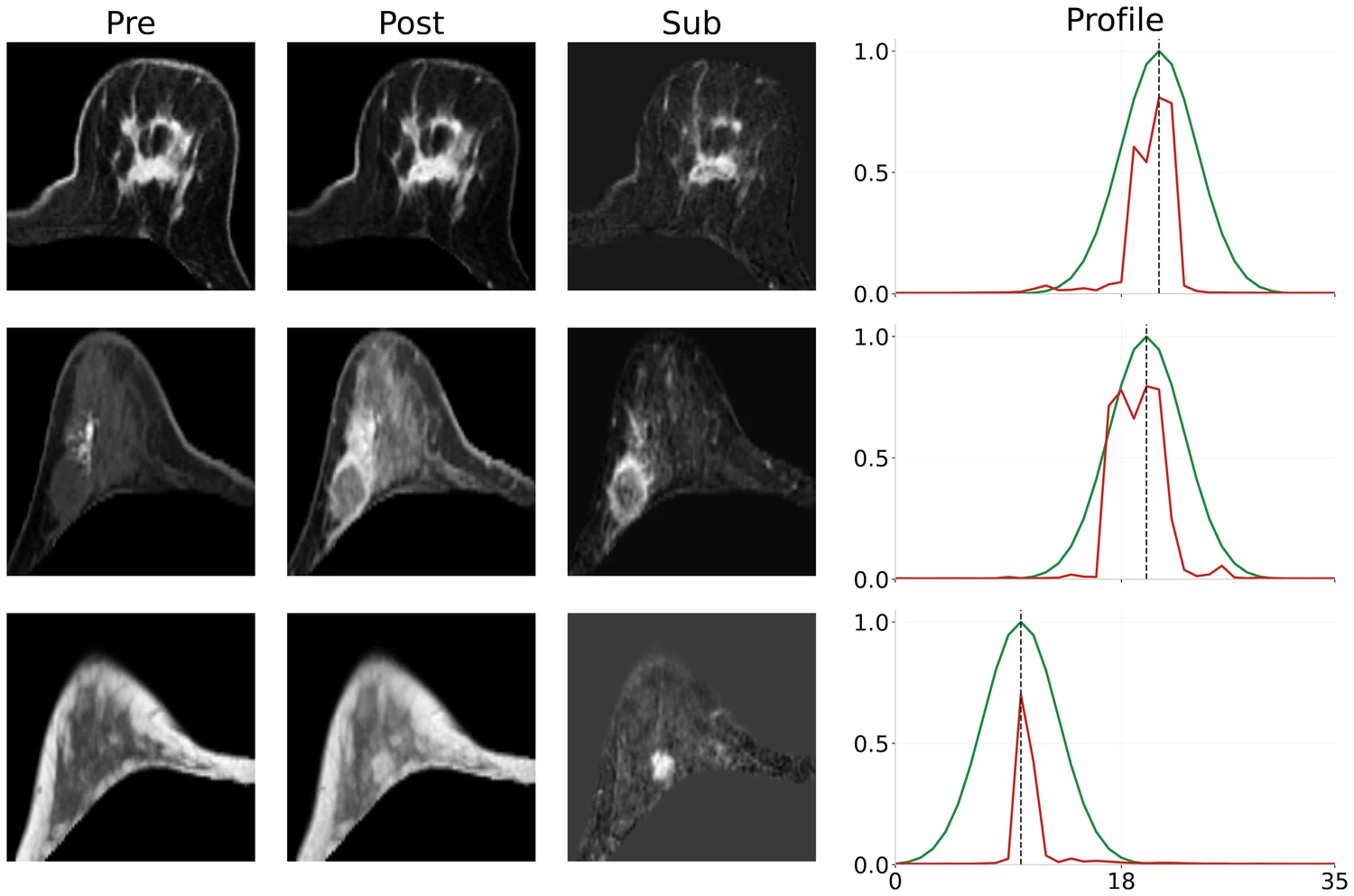 Three rows of breast MRI, each showing pre-contrast, post-contrast and subtraction images alongside a slice probability profile in which the predicted red curve peaks under the green Gaussian target at the radiologist-indicated slice