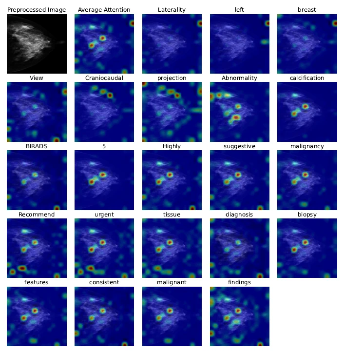 Grid of attention heatmaps over a single mammogram, one panel per generated report token, including laterality, left, breast, view, craniocaudal, abnormality, calcification, BIRADS, 5, highly, suggestive, malignancy, recommend, urgent, tissue, diagnosis, biopsy, features, consistent, malignant and findings
