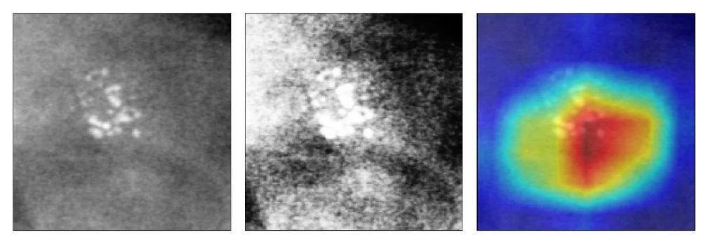 Three panels: an original mammography patch with a visible calcification cluster, the same patch after histogram equalization showing heavy noise amplification, and a Grad-CAM heatmap from the P equals 1 model in which the hot region covers the cluster but the prediction is wrong
